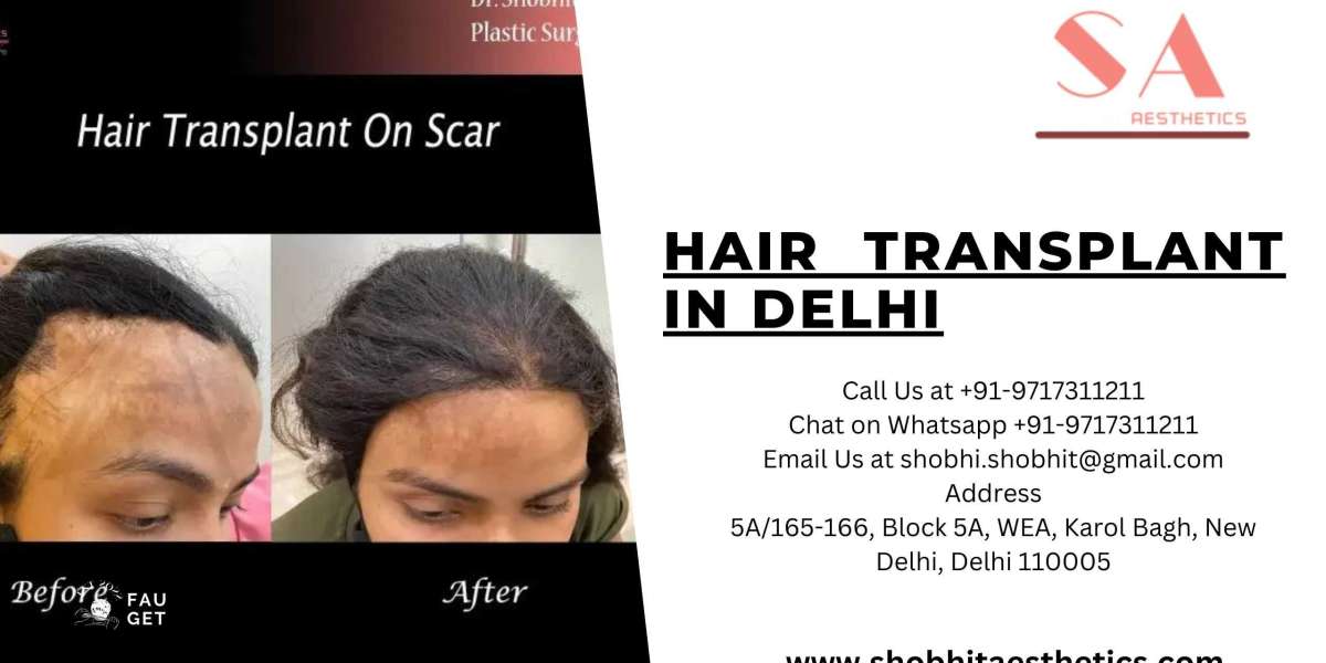 hair transplant surgeon in delhi