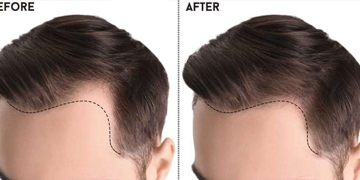 Decoding Excellence: A Deep Dive into the Best Hair Transplant in Pakistan