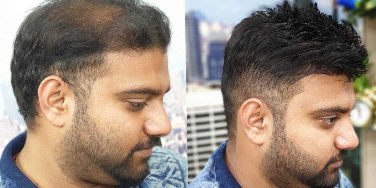 The Apex of Follicular Excellence: Unraveling the Best Hair Transplant in Islamabad